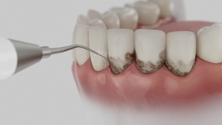 Trusted Wisdom Tooth Removal service in Ross, OH - Dentist Open Now